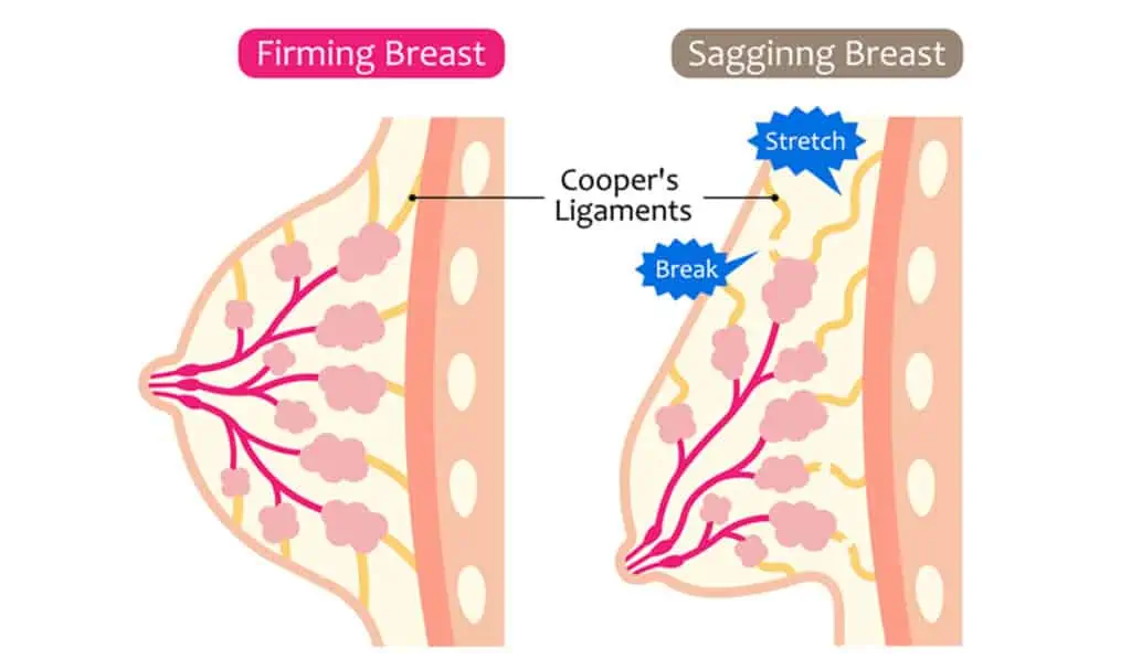 Breast Sagging 1 شد الصدر
