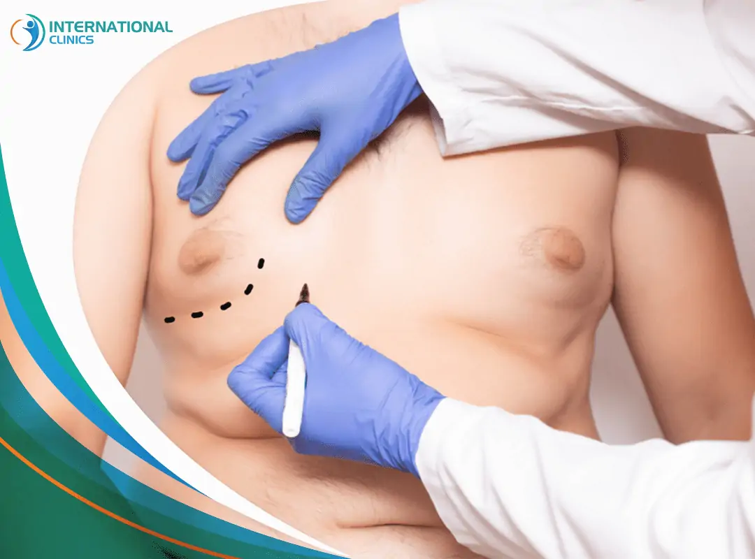 Gynecomastia Surgery in Turkey عمل ژنیکوماستی در ترکیه
