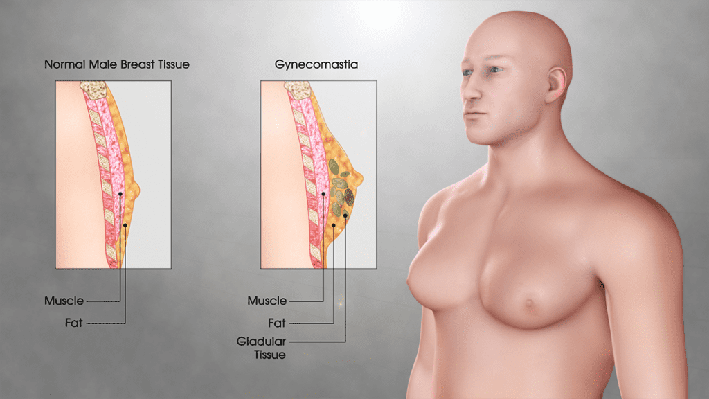 What is Gynecomastia? - Hair Transplant Turkey