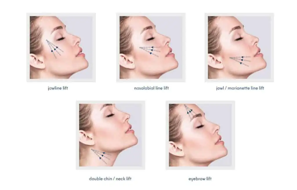 Steps of Facelift 01 Estiramiento Facial