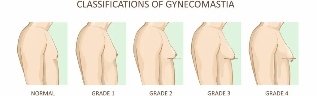 gynecomastia grades type image scaled 1 Chirurgie de gynécomastie en Turquie