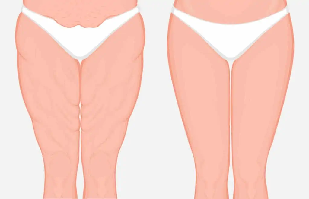 legs liposuction 2 Lipoláser