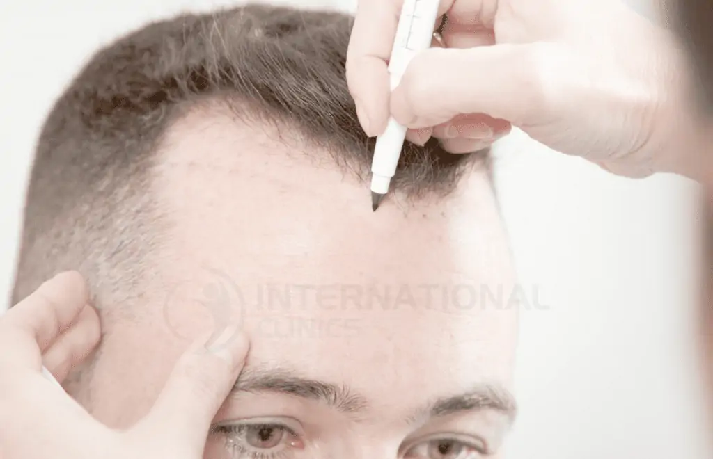 زراعة الشعر بتقنية البيركوتان