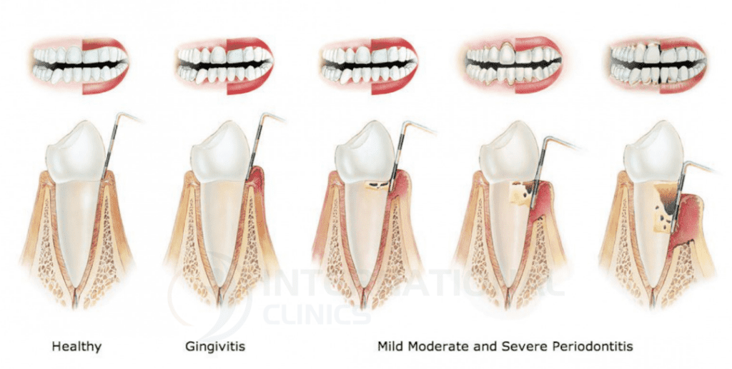 معالجة جذور الأسنان