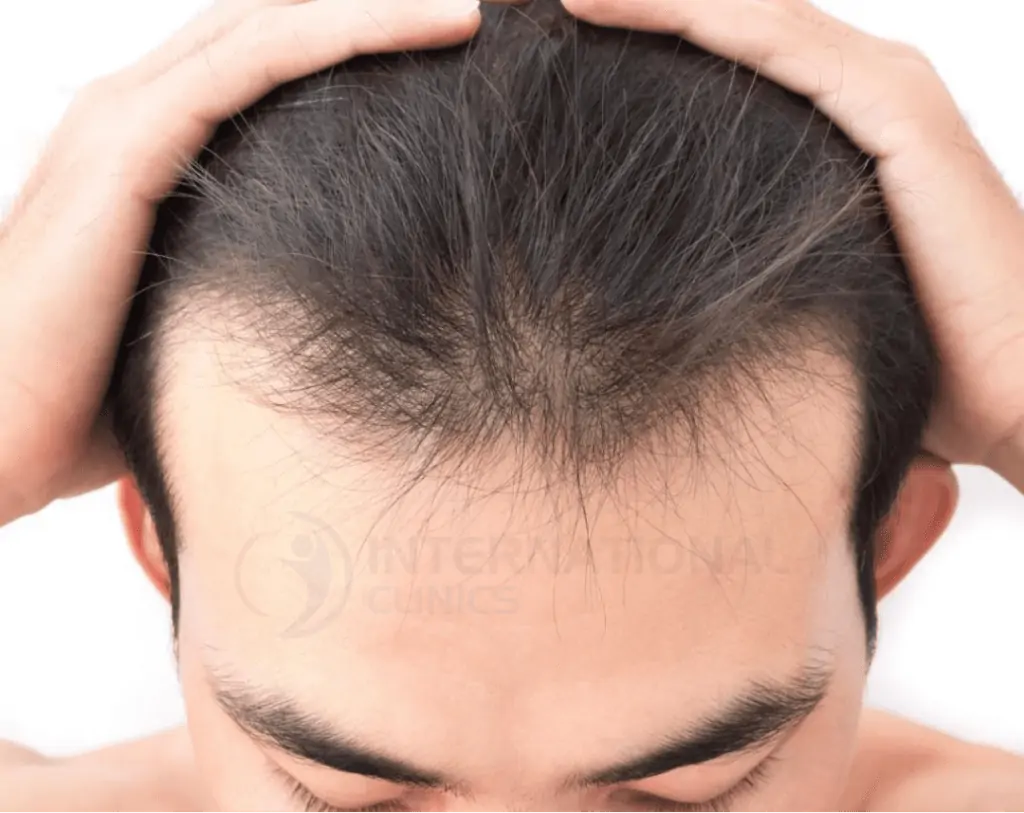 عملية زراعة الشعر