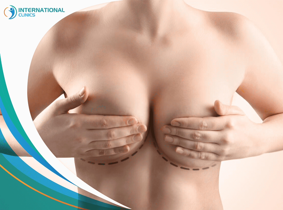 عملية رفع الثدي بالخيوط: الطرق والميزات والخطوات