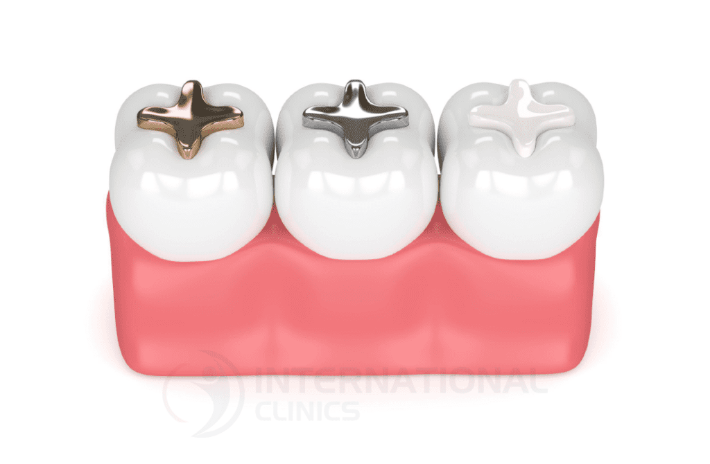 تصنف حشوات الأسنان أهم فروع العلاج التحفظي للأسنان