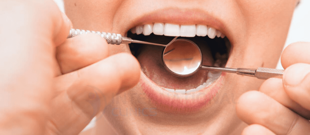 زراعة الأسنان هي عملية يتم من خلالها استبدال جذور الأسنان بدعامات معدنية