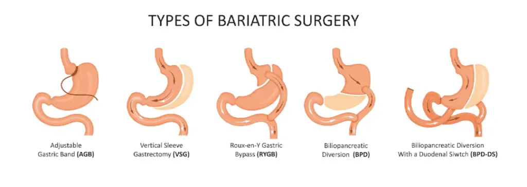 Tipos de Procedimientos Bariátricos