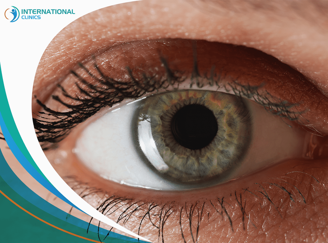 Glaucoma Treatment in Turkey: Surgery & Other Options