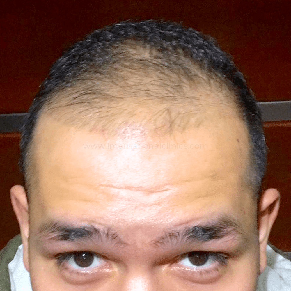 Hair Before 1 Liposucción de Cadera