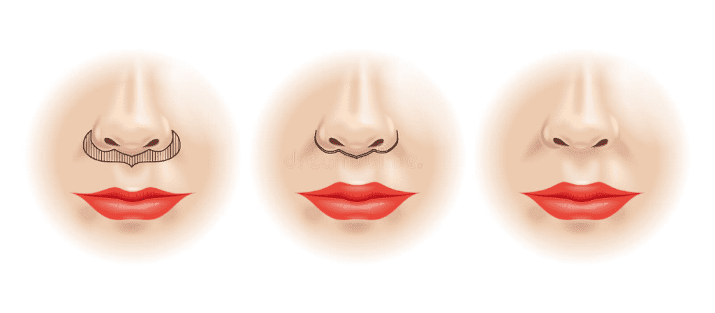 Lips plastic surgery cover 1 تكبير الشفايف