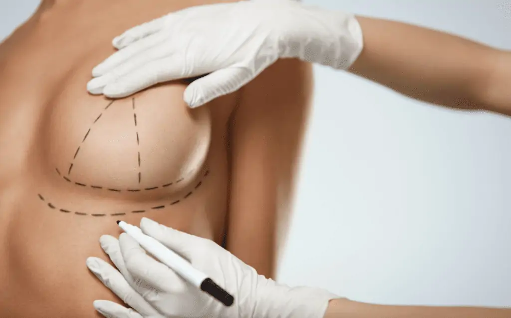 Plasma injection for breast augmentation 1 تكبير الثدي بدون جراحة