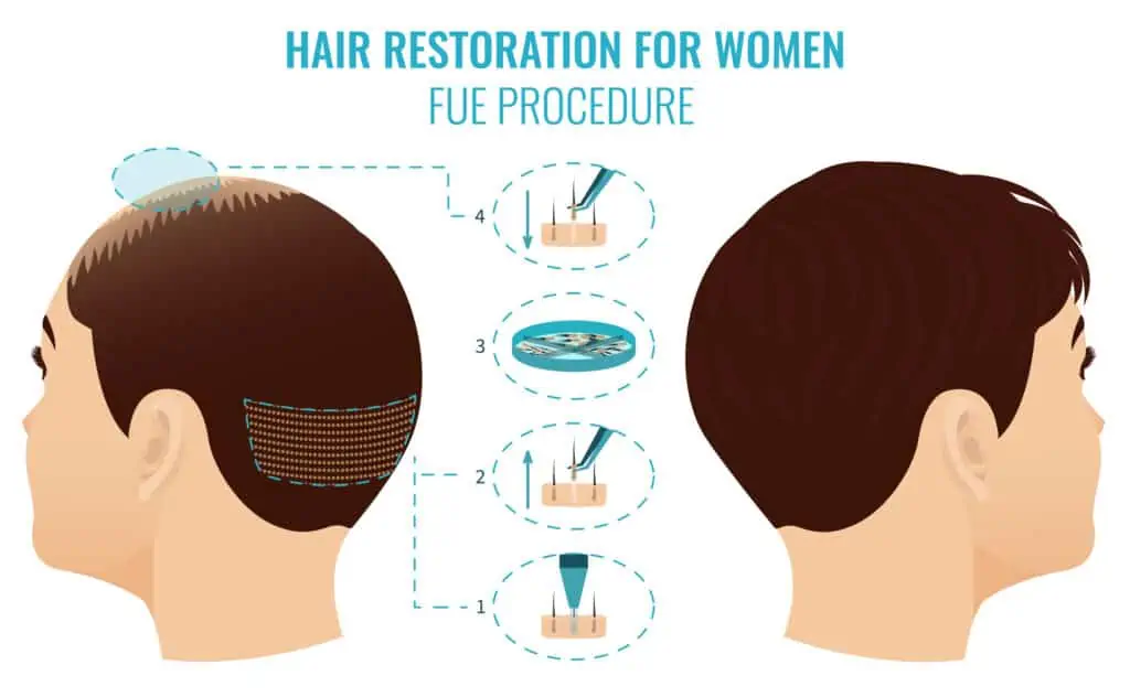 ما هي الخطوات في عملية زراعة الشعر بطريقة FUE