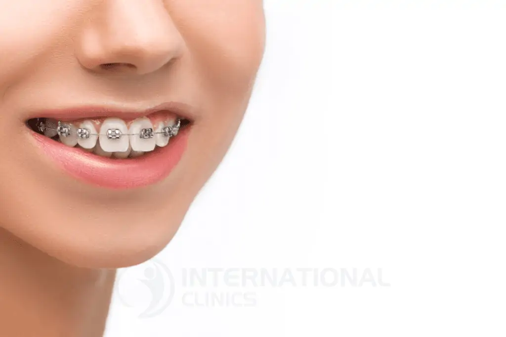 تقيوم الأسنان في حالة وجود بروز او اعوجاج او فراغات بالأسنان