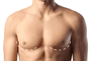 cover image gynecomastia لیپوساکشن