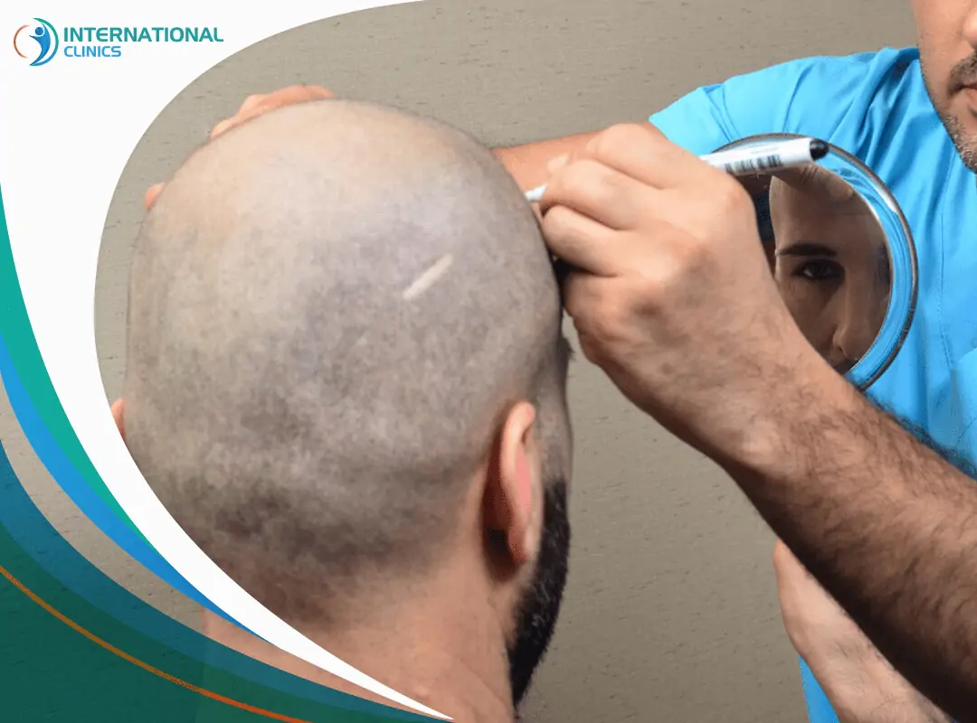  الفرق بين عمليات زراعة الشعر في تركيا وإيران | دليل شامل