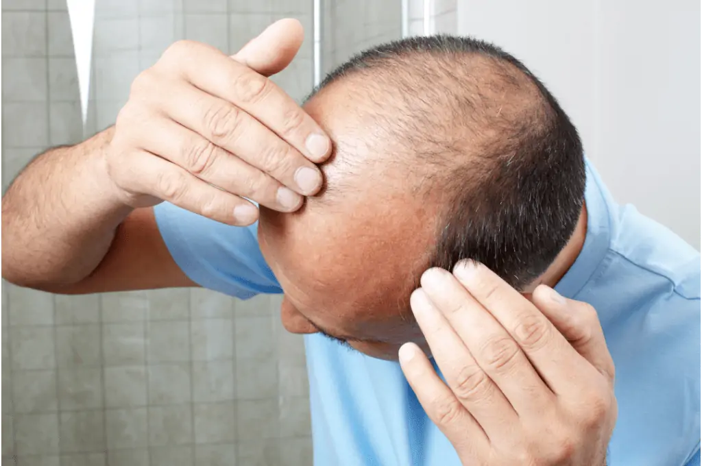علاج الصلع - زراعة الشعر