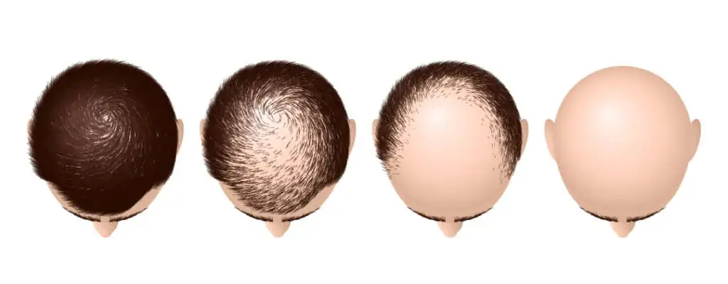تقنية سفير لزراعة الشعر