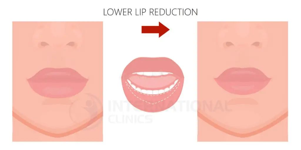lip reduction cover 1 تصغير الشفايف