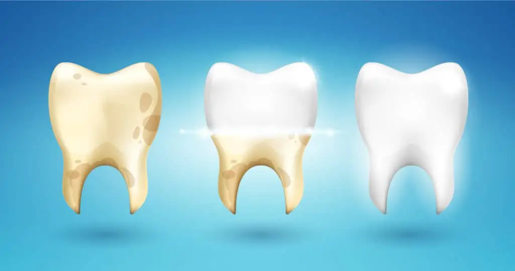 تبييض الأسنان من أشهر انواع عمليات تجميل الأسنان