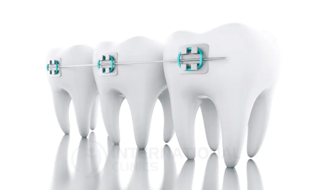 من ماذا يتكون تقويم الأسنان ؟