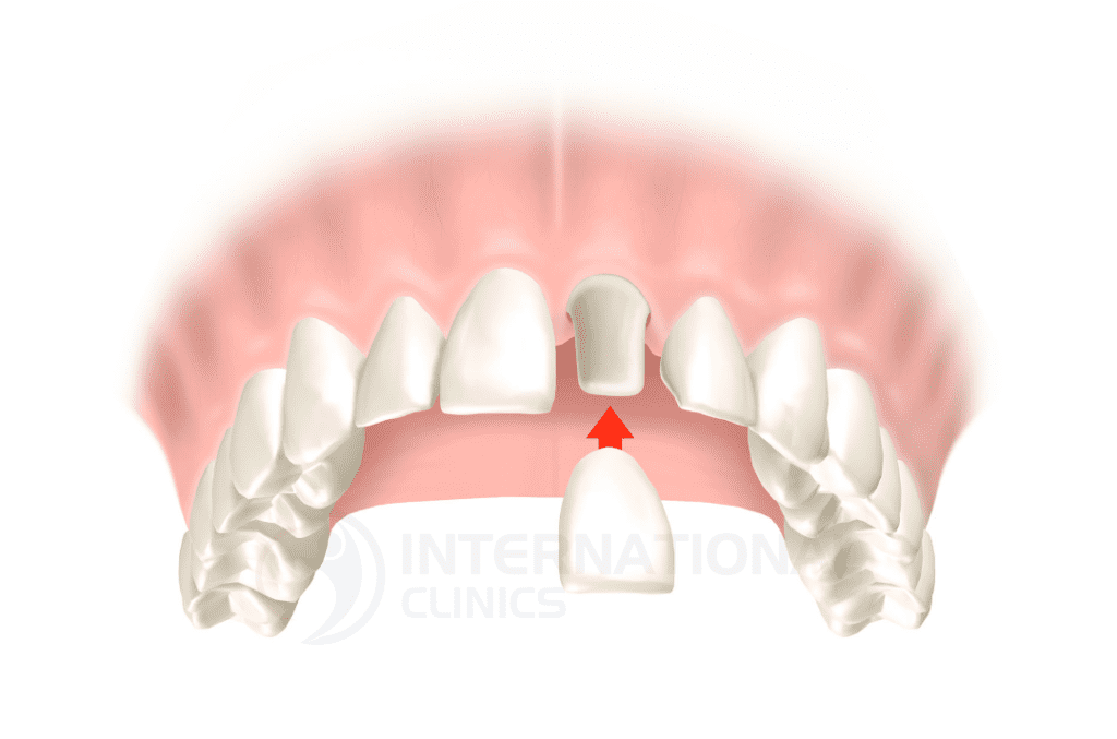 ما هو لومينيرالأسنان؟