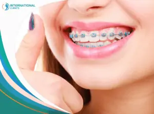 485b5151432794be7c622cd709257763 تلبيس الأسنان في تركيا