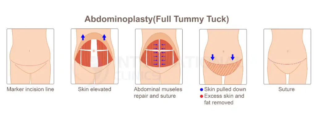 Abdominplasty full tummy tuck
