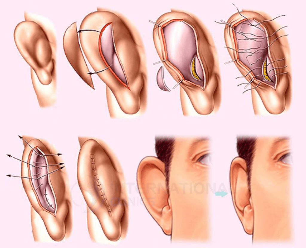 خطوات ومراحل العملية الجراحية لـ تجميل الأذنين