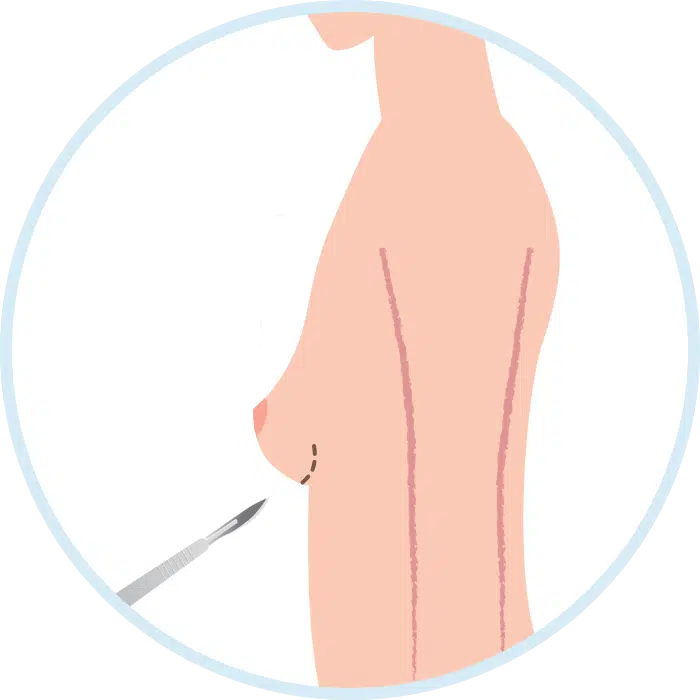 2. Incisions Making