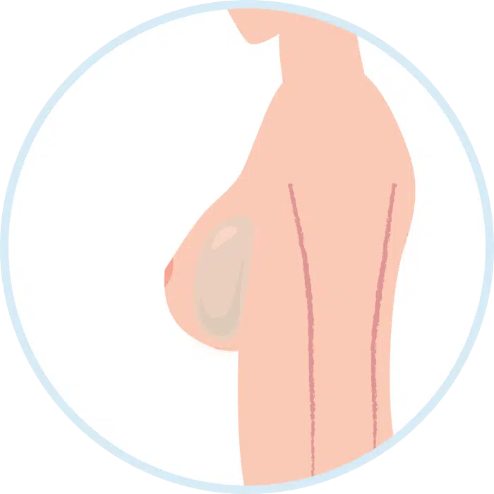 d544fb56be652ef8758466794e201a1b Breast Augmentation,breast augmentation cost,breast augmentation in turkey