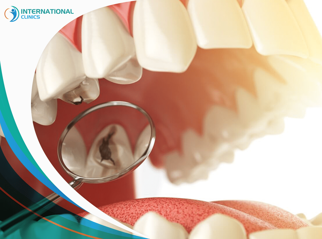 علاج تسوس الأسنان | الطرق والخطوات ونصائح مهمة