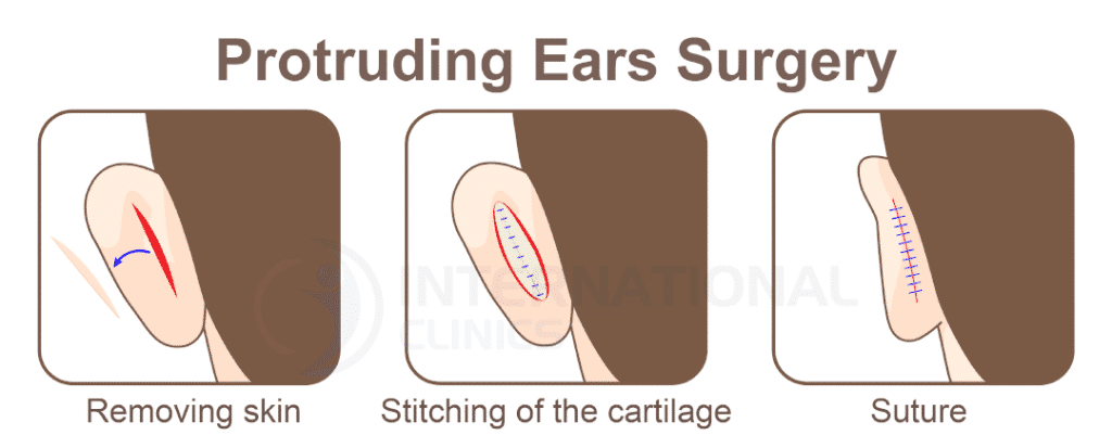 عملية تجميل الأذن البارزة