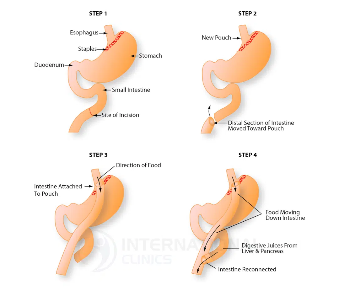Types of Gastric baypass