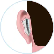 69973abedcb0db01ec7815b6cac3d995 جراحی گوش (اتوپلاستی)