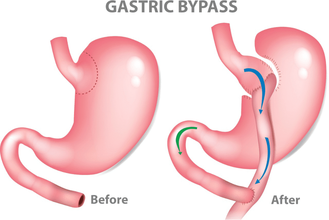 Gastric Bypass Surgery before and after