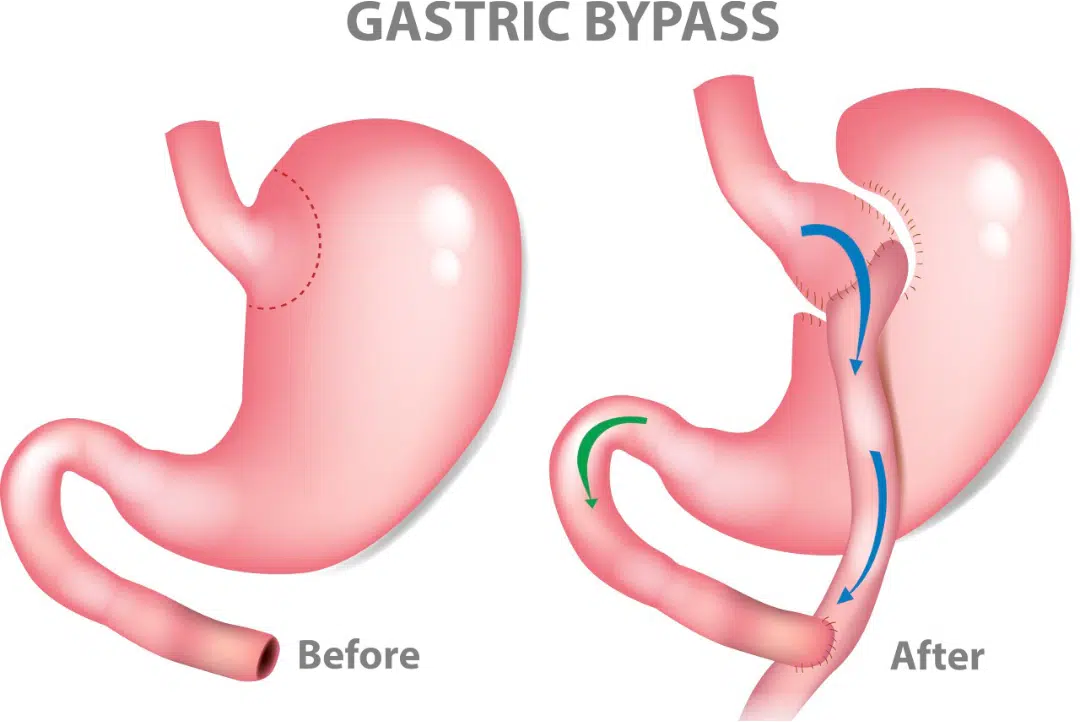 Gastric Bypass Surgery before and after