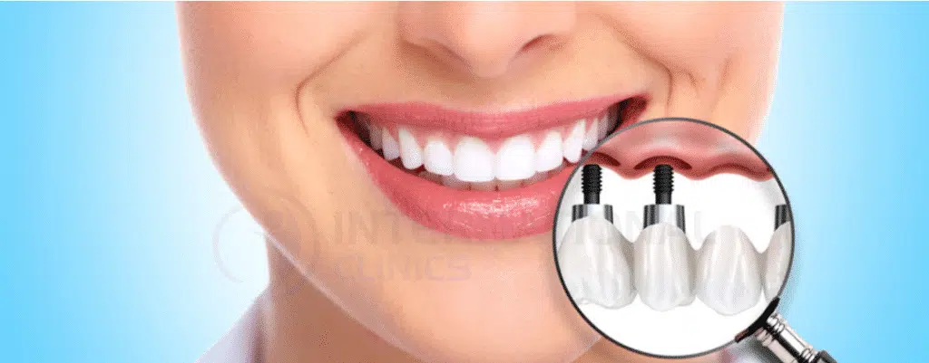 86d8c55219937cd753e44999863506d0 علاج الأسنان في تركيا