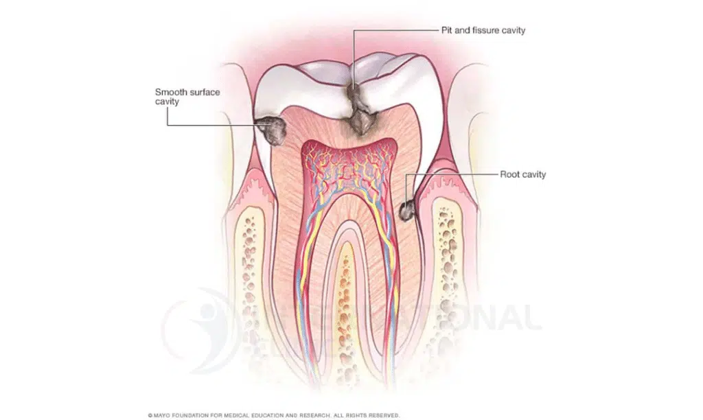 b546040307c15cacc7bf7419ac7de6cb تسوس الأسنان عند الاطفال