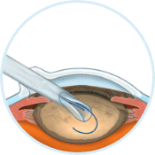 5. لنز داخل چشمی را کاشت کنید
