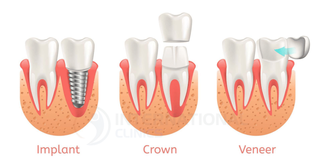 أنواع ابتسامة هوليوود