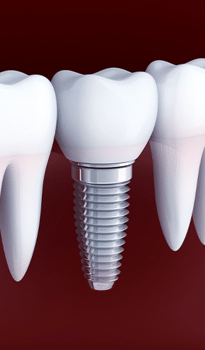 e3e80ad7f19c5c8300b4b11cb56971d0 Cirugía de Implantes Dentales
