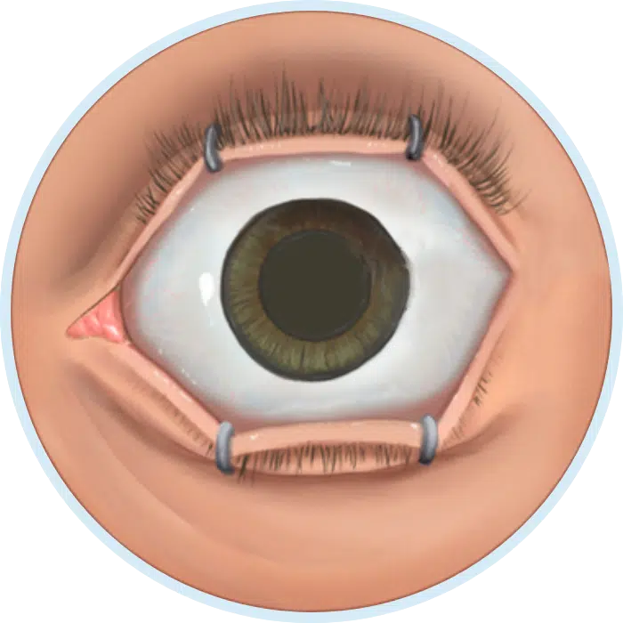 fa0ce6723f92caf8be548d809ebbc253 Cirugía Ocular LASIK