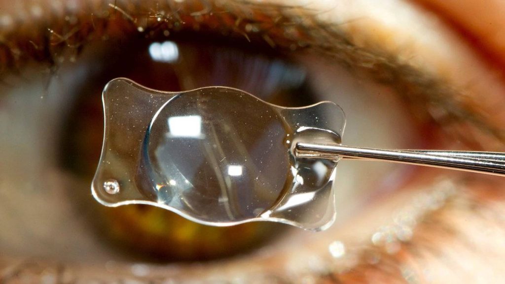 زراعة العدسات داخل العين