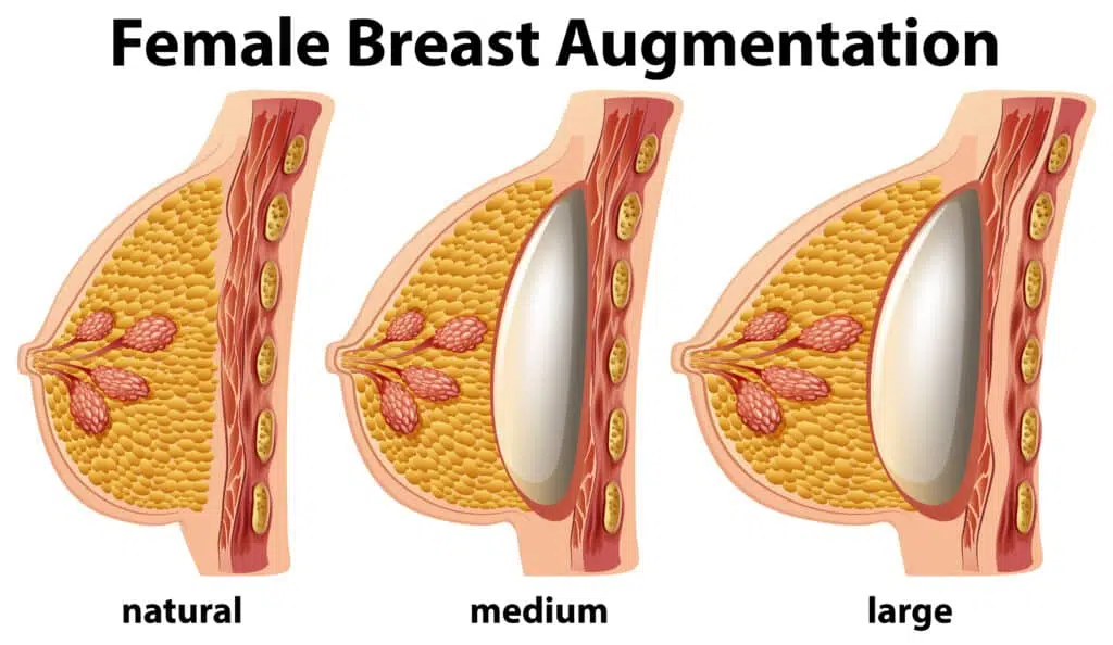 breast augmentation in turkey sizes