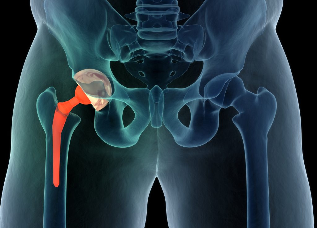 ما هي عملية تغيير مفصل الورك (Hip Joint Replacement)؟