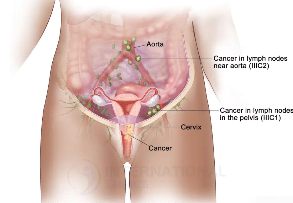 أعراض سرطان عنق الرحم