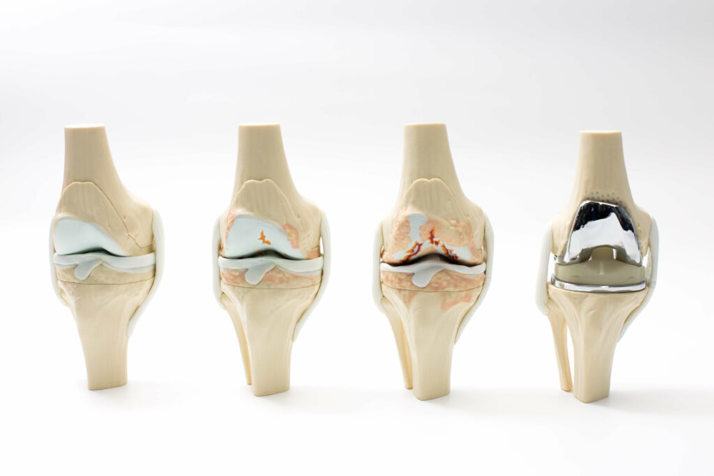 ما هي عملية استبدال مفصل الركبة؟