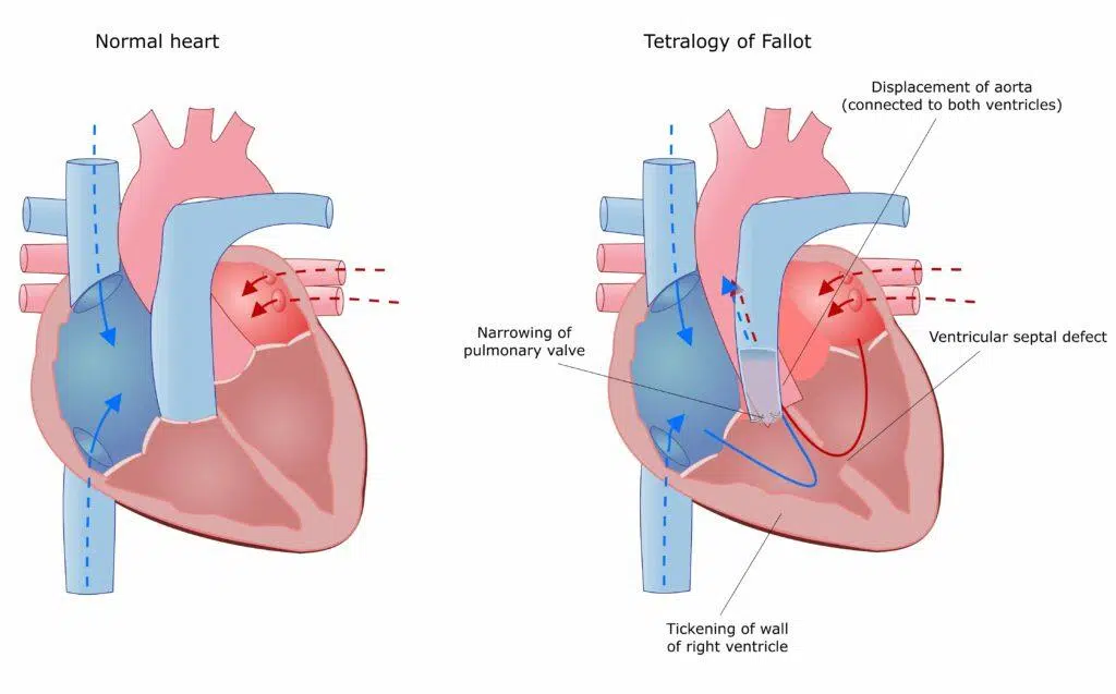 ما هي أمراض القلب الخلقية (Congenital heart disease)؟